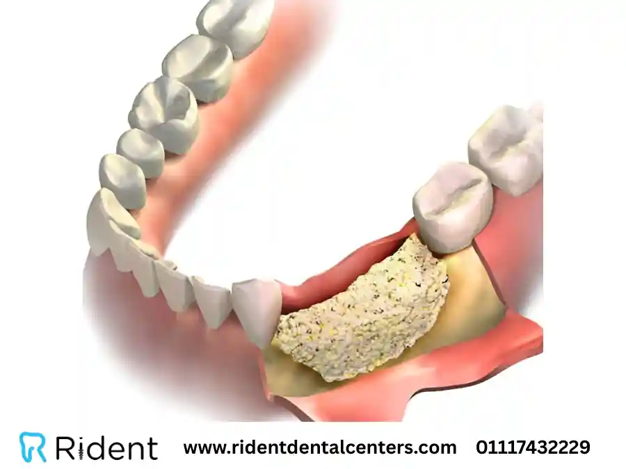 زراعة عظم الفك من الألف للياء و4 حالات تحتاج إليها